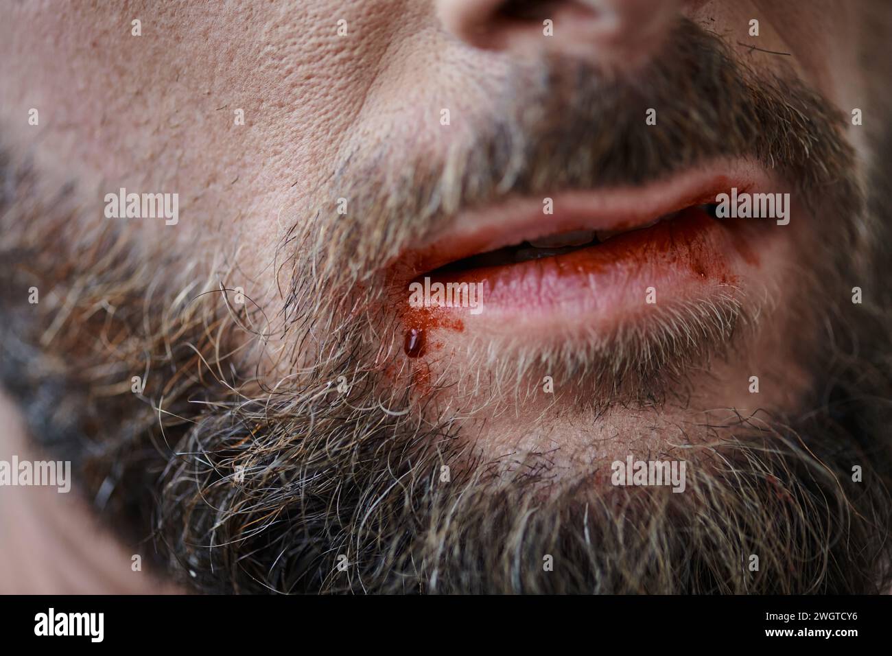 Zugeschnittene Ansicht eines ängstlichen Mannes mit Bart, der während einer depressiven Episode auf die Lippen beißt Stockfoto