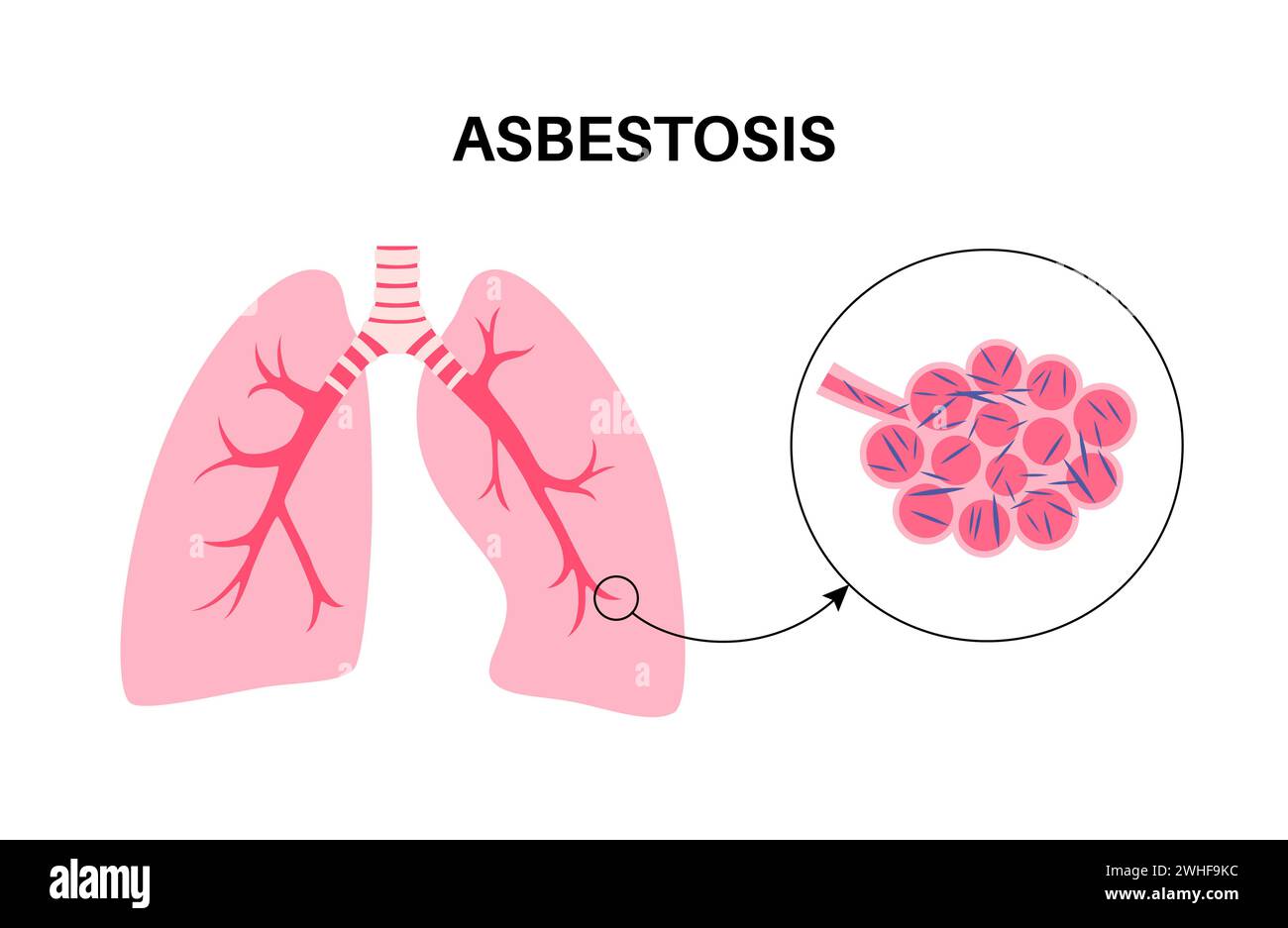 Asbestose-Lungenerkrankung, Illustration Stockfoto