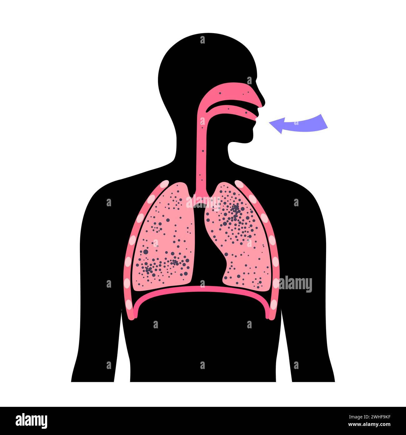 Pneumokoniose Lungenerkrankung, Illustration Stockfoto