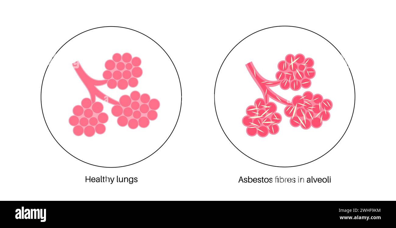 Asbestose-Lungenerkrankung, Illustration Stockfoto