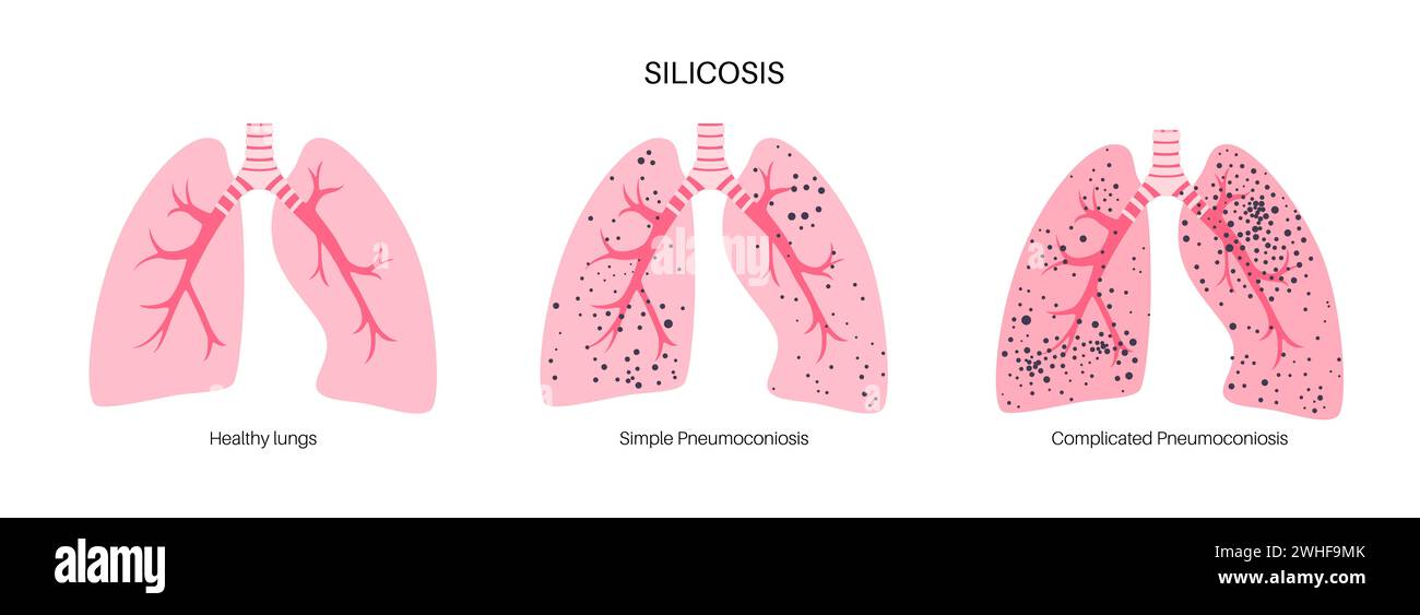 Silikosestaub in der Lunge, Illustration Stockfoto