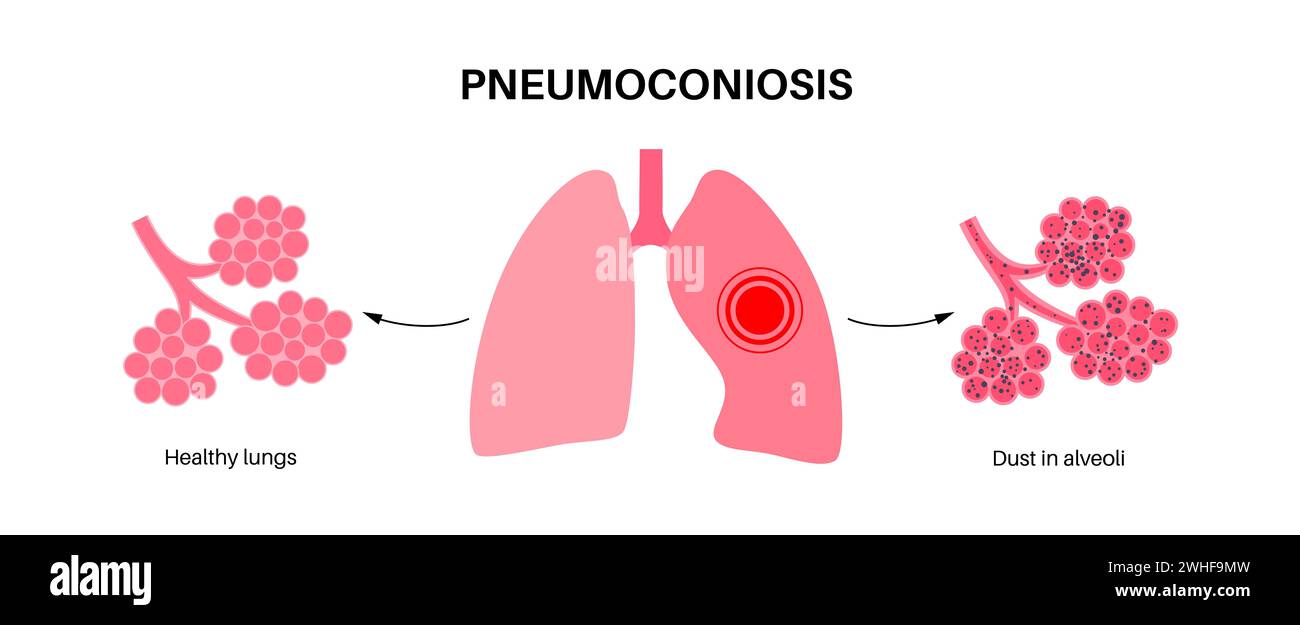 Pneumokoniose Lungenerkrankung, Illustration Stockfoto