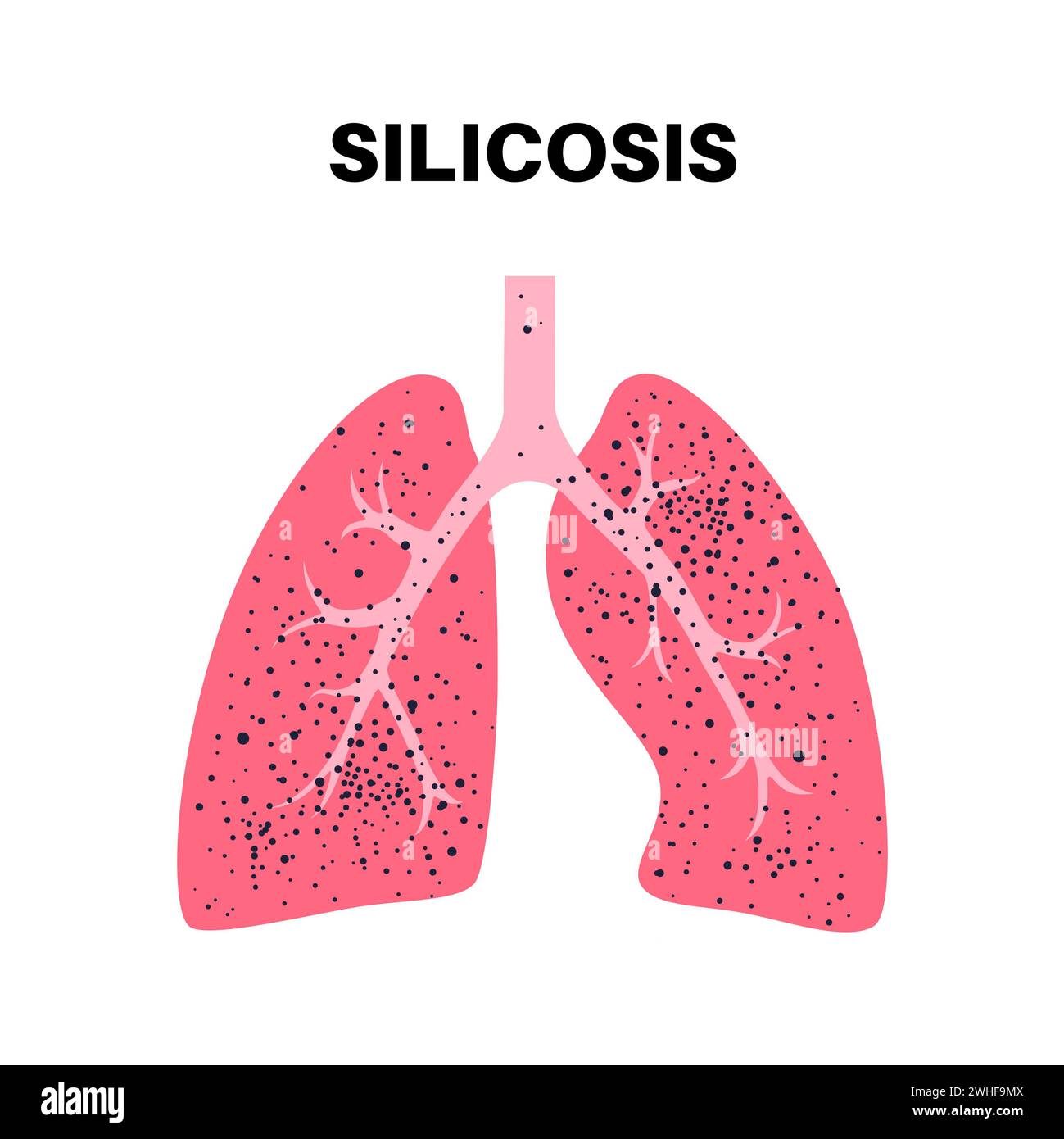 Silikosestaub in der Lunge, Illustration Stockfoto