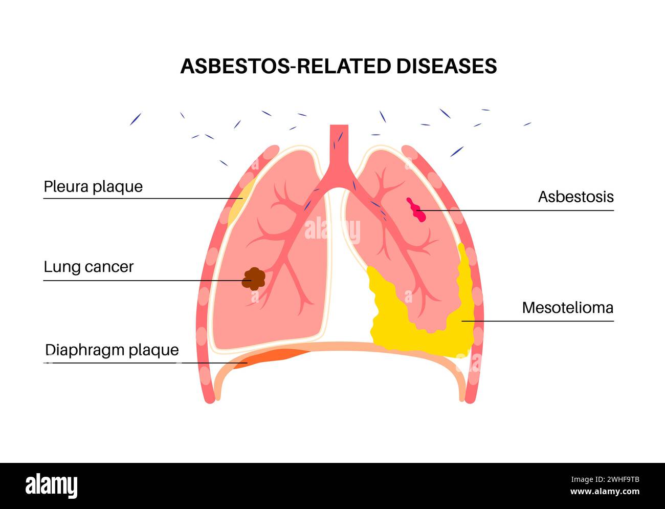 Asbestbedingte Erkrankungen, Illustration Stockfoto