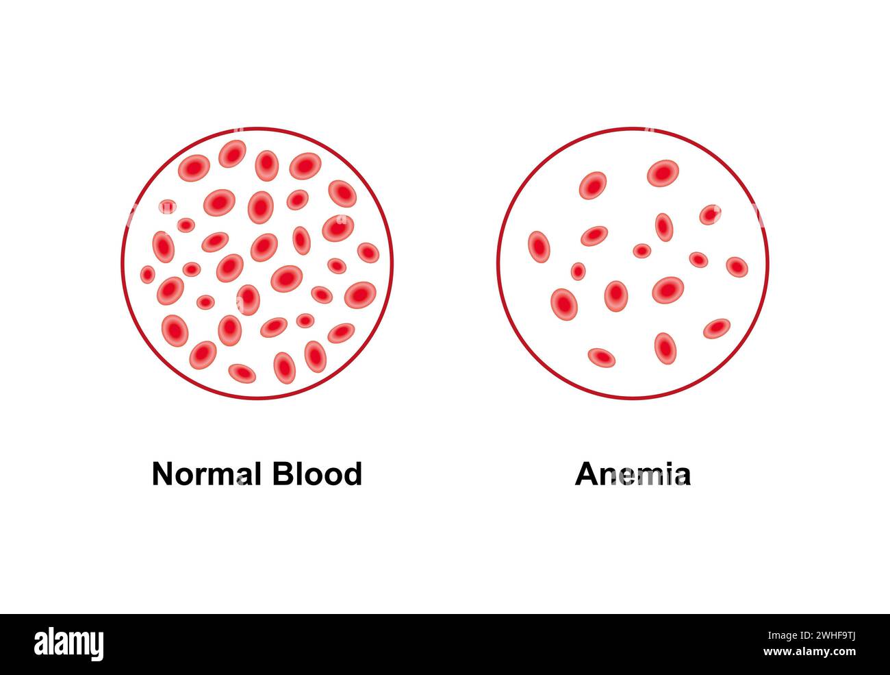 Normales und anämisches Blut, Illustration Stockfoto