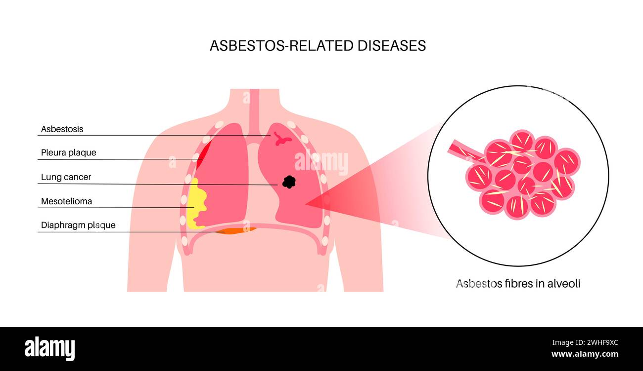 Asbestbedingte Erkrankungen, Illustration Stockfoto