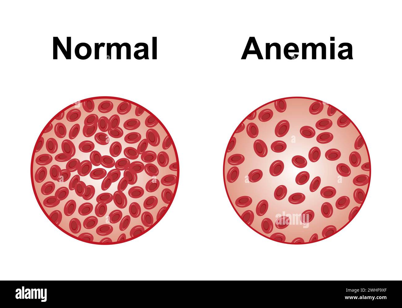 Normales und anämisches Blut, Illustration Stockfoto