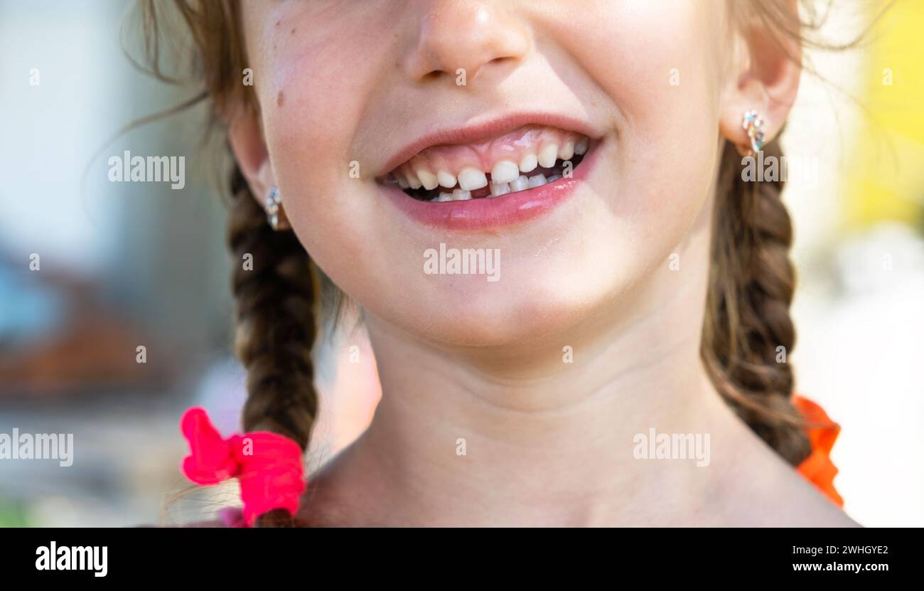 Zahnloses glückliches Lächeln eines Mädchens mit einem gefallenen Milchzahn aus der Nahaufnahme. Zahnwechsel zu Backenzähnen im Kindesalter Stockfoto