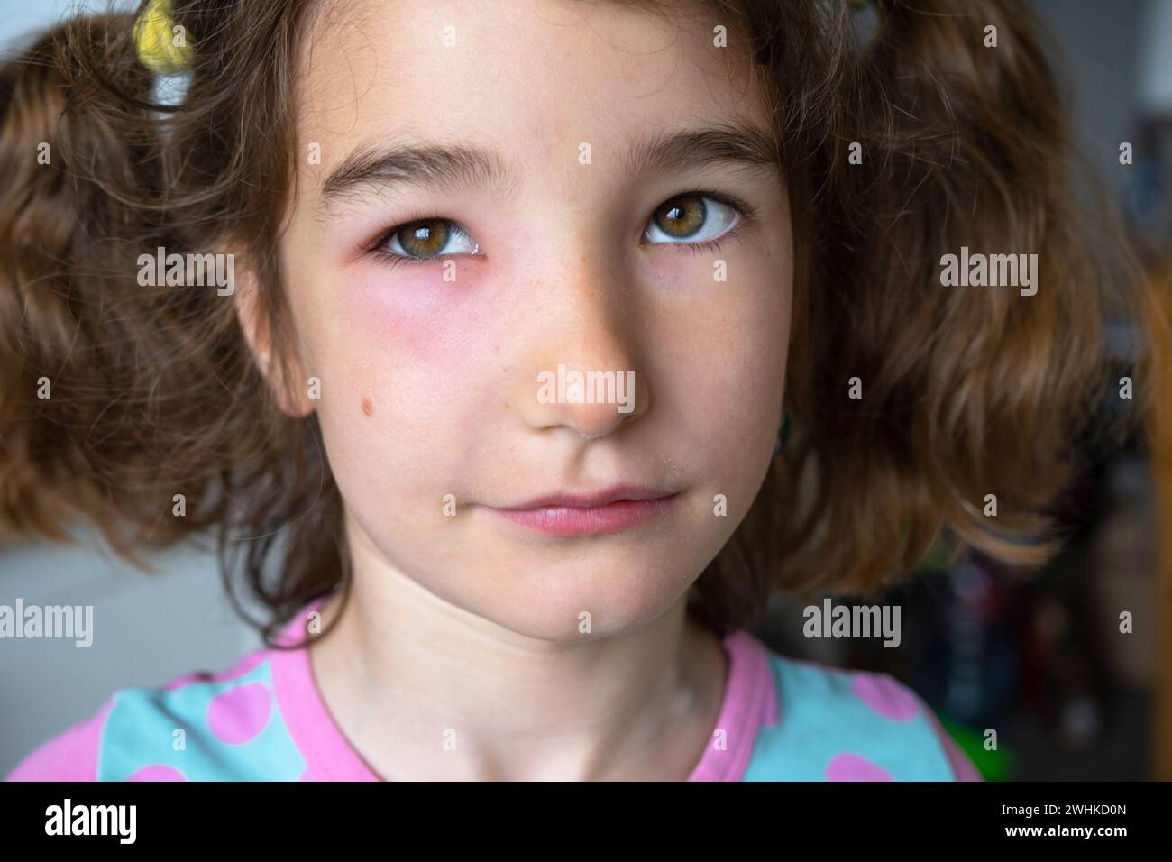 Ein rotes geschwollenes Augenlid auf einem Kindergesicht in Nahaufnahme ist eine Allergie gegen einen Insektenbiss. Allergische Reaktion auf blutsaugende Insekten Stockfoto
