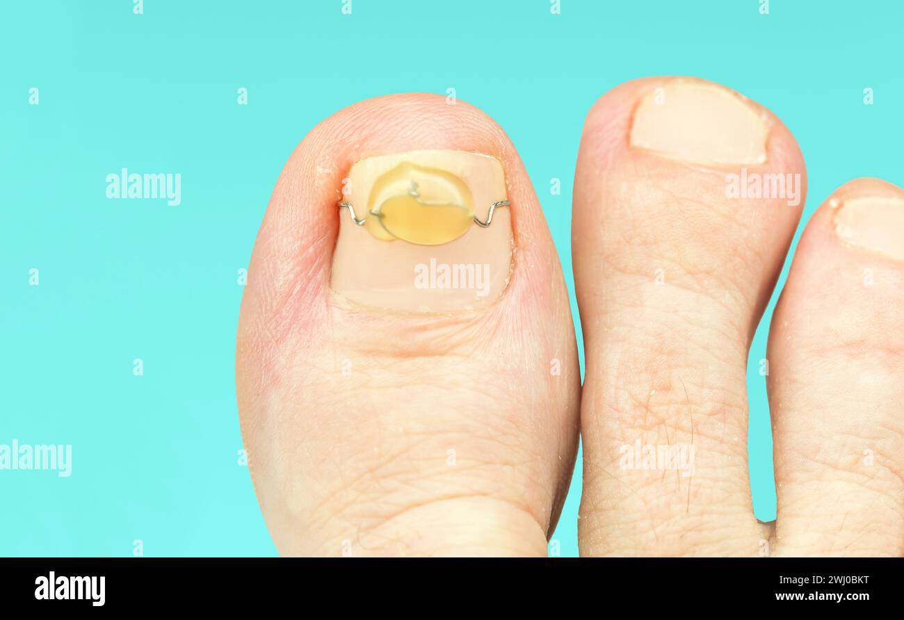 Zehennagel Löst Sich Ab Nach Wanderung Eingewachsener zehennagel -Fotos und -Bildmaterial in hoher Auflösung