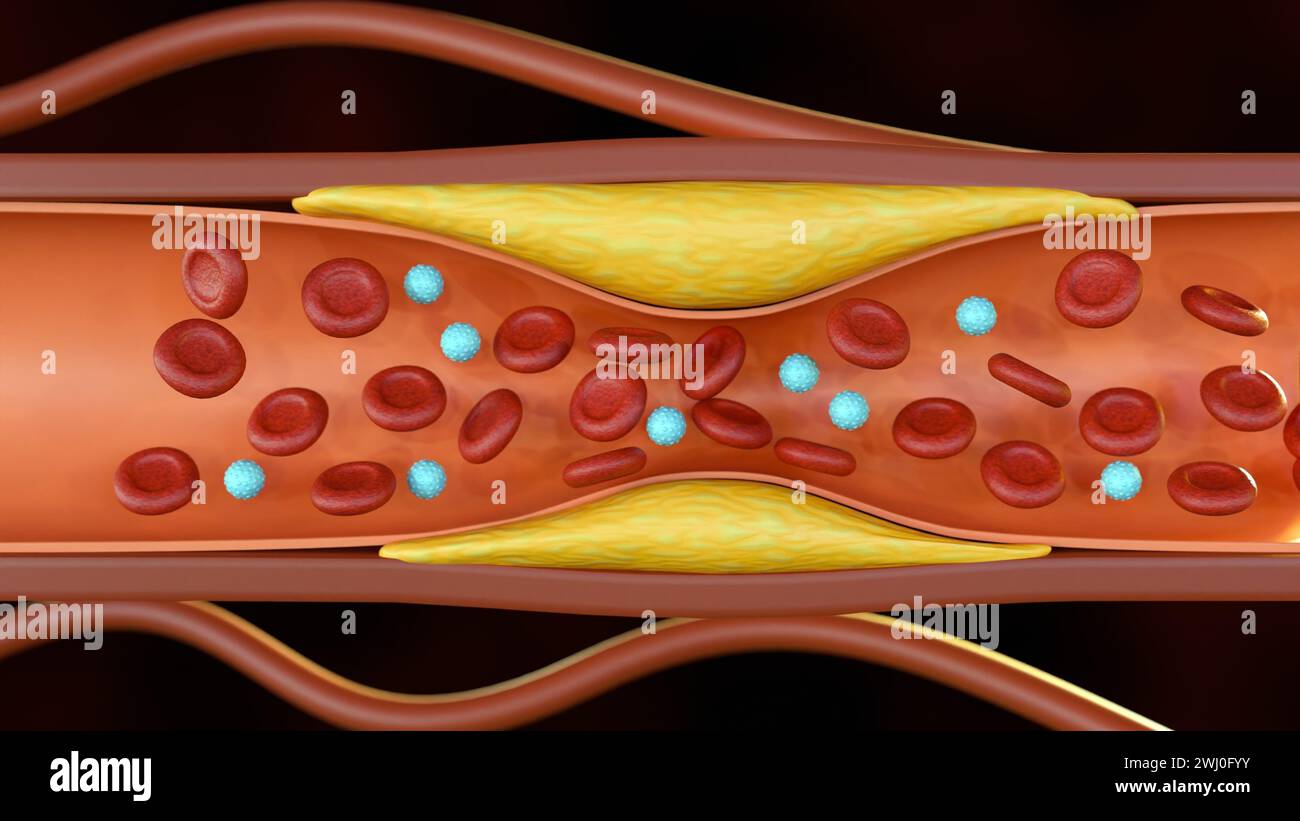 3D-Darstellung der Plaque-Bildung von Cholesterin in der Arterie (Atherosklerose) Stockfoto