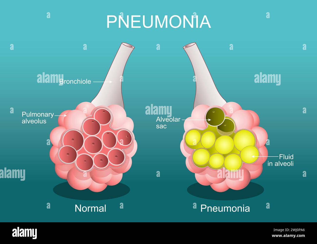 Pneumonie. Entzündungszustand der Lunge. Querschnitt der normalen Alveolen und Alveolen sind mit Flüssigkeiten gefüllt. Vektorposter. Isometrische Ebene Stock Vektor