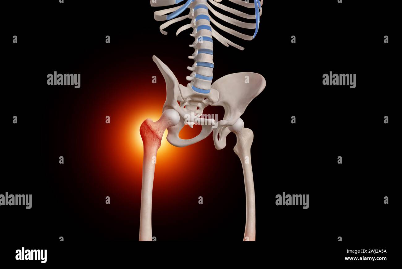 Intertrochantere Fraktur am Oberschenkelkopf-Skelett 3D-medizinische Illustration Stockfoto