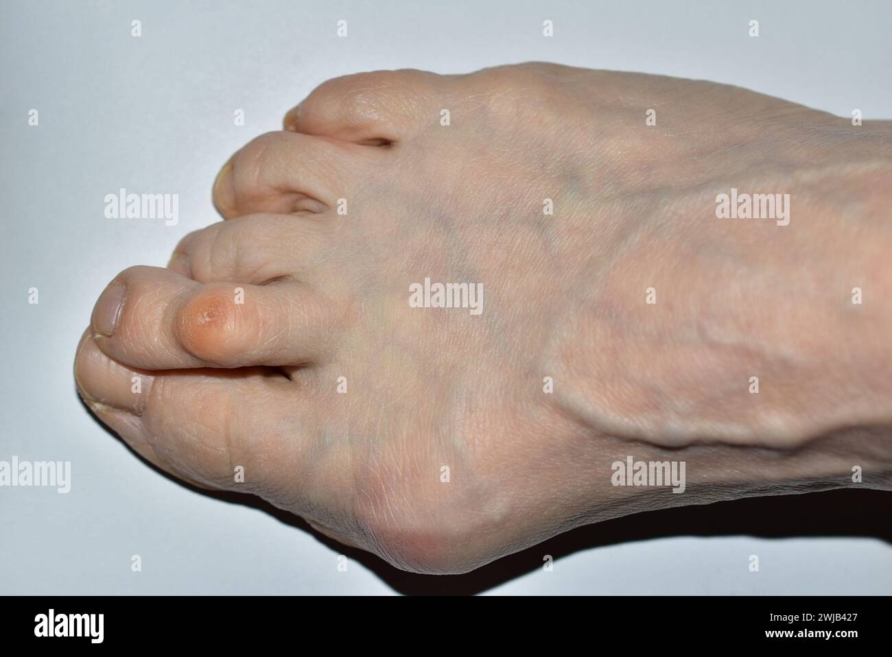 Das Bild zeigt eine Draufsicht des rechten Fußes einer Frau, die von der Krankheit Hulux valgus betroffen ist, die Zehen sind verdreht. Stockfoto