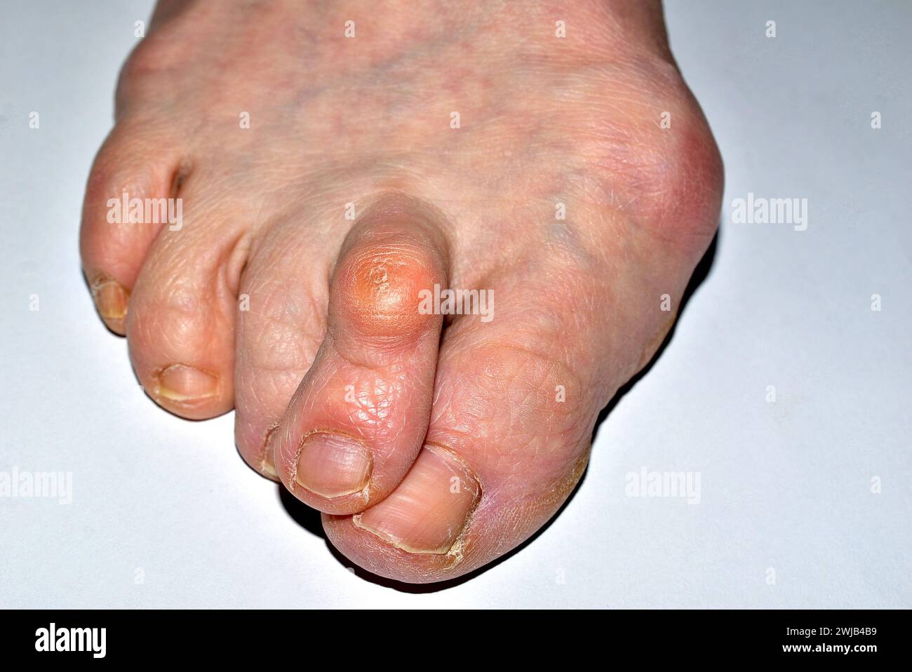 Das Bild zeigt eine Nahaufnahme des rechten Fußes des von der Krankheit betroffenen Beins, des Hallux valgus, die Zehen sind verdreht. Stockfoto