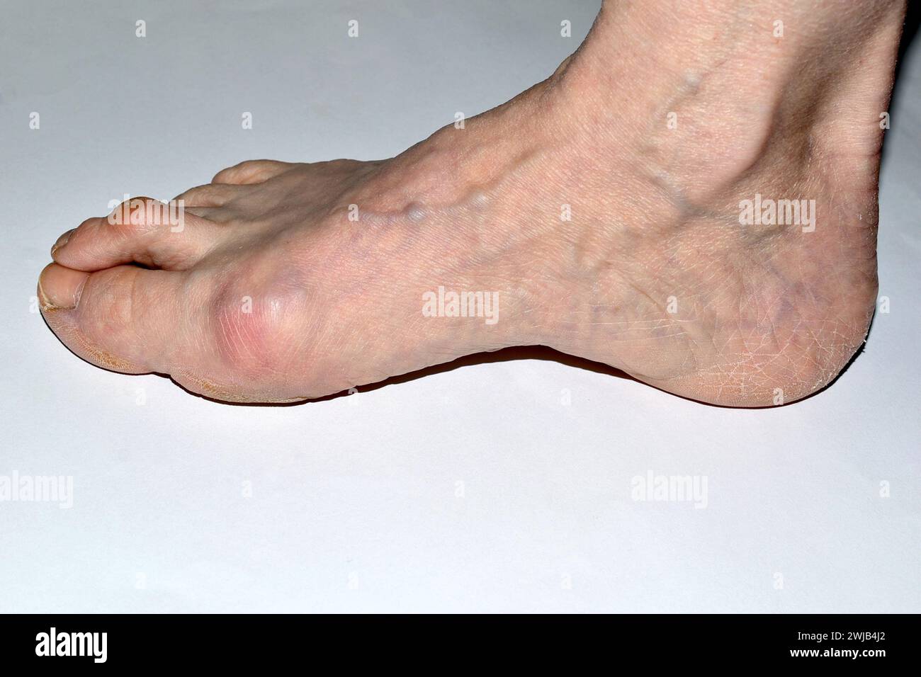 Das Bild zeigt den rechten Fuß des Beines, der von der Erkrankung des Hallux valgus betroffen ist. Stockfoto