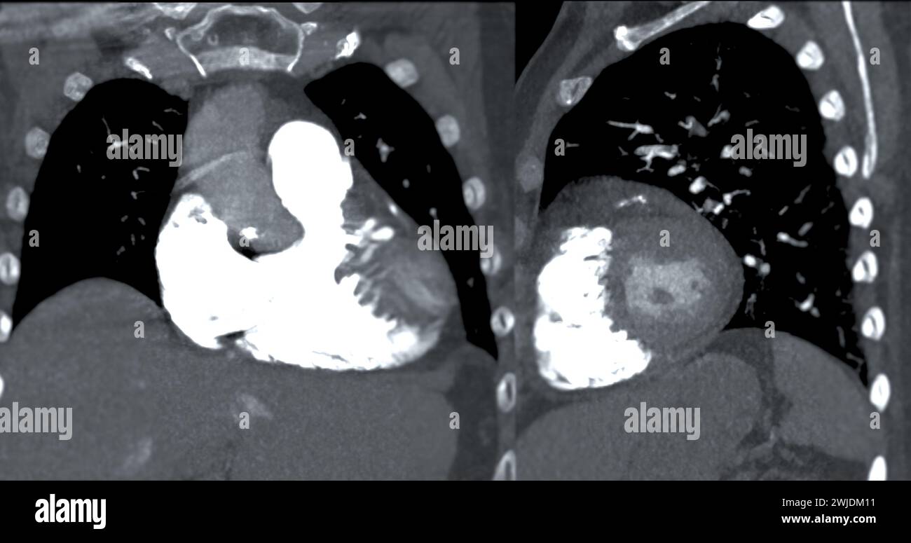 Eine CTA Pulmonalarterie zeigt eine detaillierte Ansicht der Lungenblutgefäße und erfasst das Vorhandensein einer Lungenembolie. Stockfoto