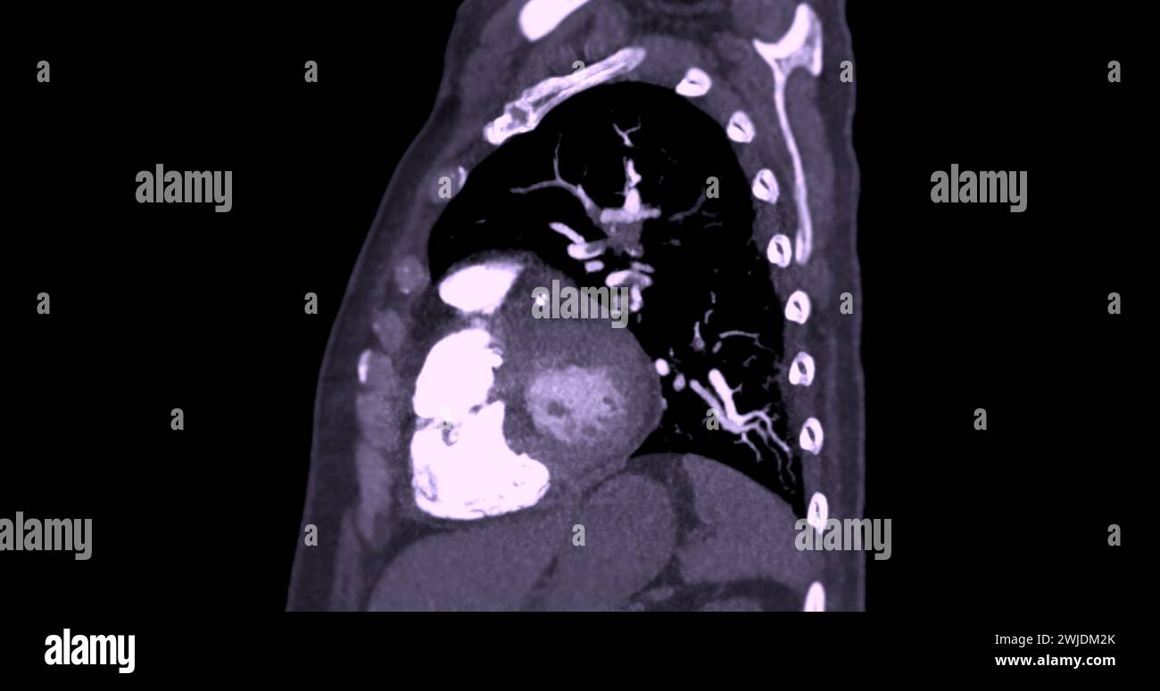 Eine CTA-Pulmonalarterie zeigt eine detaillierte Ansicht der Lungenblutgefäße und erfasst das Vorhandensein einer Lungenembolie, einer Erkrankung, bei der eine blutcl vorliegt Stockfoto