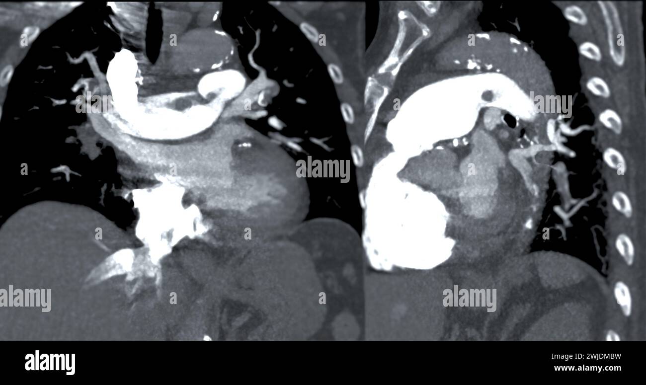 Eine CTA-Pulmonalarterie zeigt eine detaillierte Ansicht der Lungenblutgefäße und erfasst das Vorhandensein einer Lungenembolie, einer Erkrankung, bei der eine blutcl vorliegt Stockfoto