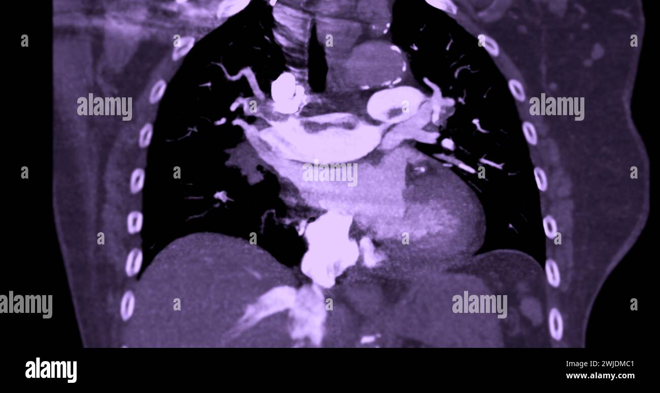 Eine CTA-Pulmonalarterie zeigt eine detaillierte Ansicht der Lungenblutgefäße und erfasst das Vorhandensein einer Lungenembolie, einer Erkrankung, bei der eine blutcl vorliegt Stockfoto