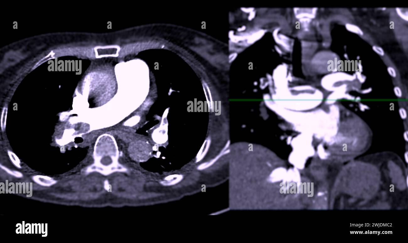 Eine CTA-Pulmonalarterie zeigt eine detaillierte Ansicht der Lungenblutgefäße und erfasst das Vorhandensein einer Lungenembolie, einer Erkrankung, bei der eine blutcl vorliegt Stockfoto