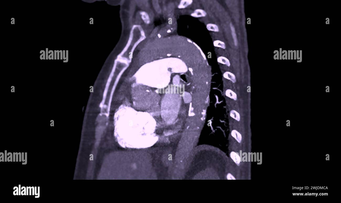 Eine CTA-Pulmonalarterie zeigt eine detaillierte Ansicht der Lungenblutgefäße und erfasst das Vorhandensein einer Lungenembolie, einer Erkrankung, bei der eine blutcl vorliegt Stockfoto