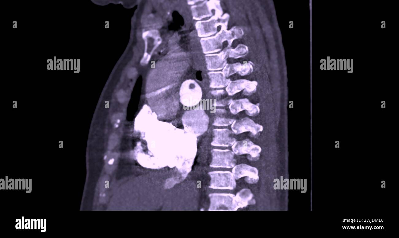 Eine CTA-Pulmonalarterie zeigt eine detaillierte Ansicht der Lungenblutgefäße und erfasst das Vorhandensein einer Lungenembolie, einer Erkrankung, bei der eine blutcl vorliegt Stockfoto