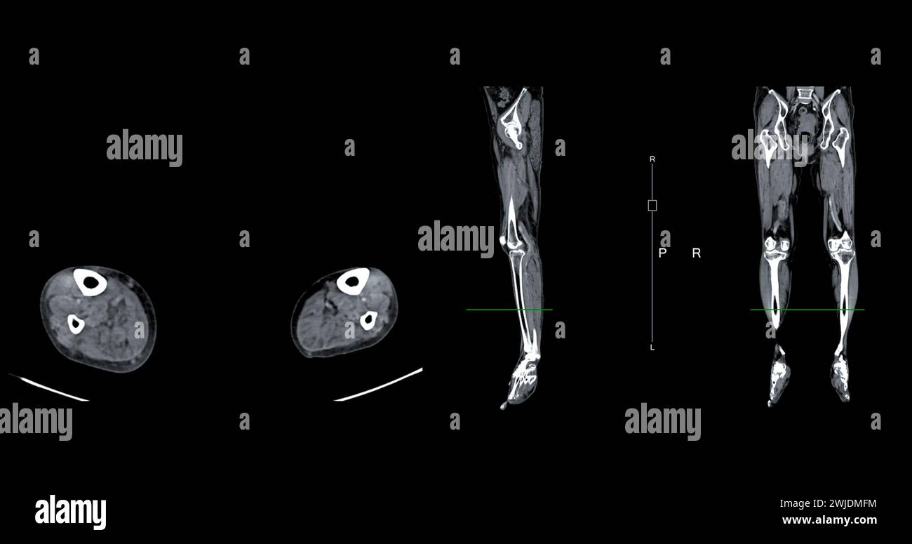 Ein CT-Venogramm des Beines ist ein nicht-invasives Bildgebungsverfahren, das detaillierte Visualisierungen der Beinvenen ermöglicht. Stockfoto