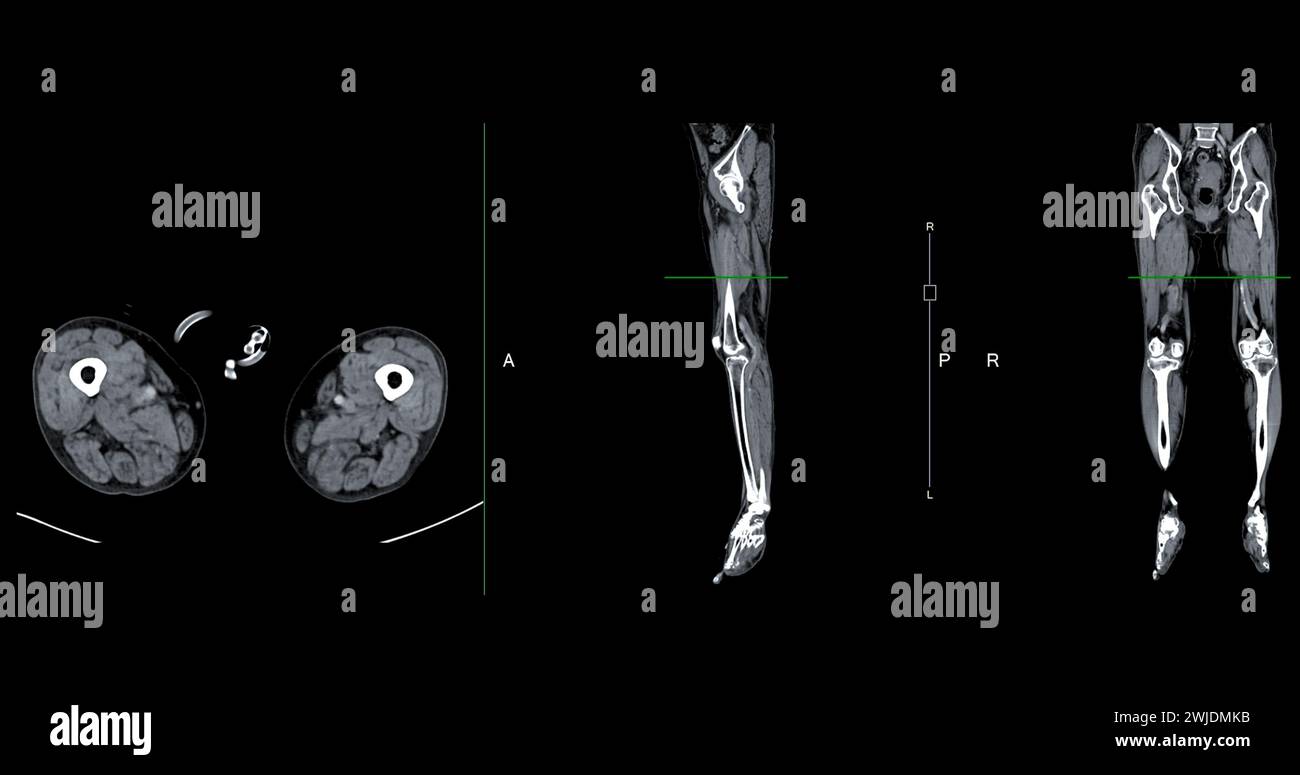 Ein CT-Venogramm des Beines ist ein nicht-invasives Bildgebungsverfahren, das detaillierte Visualisierungen der Beinvenen ermöglicht. Stockfoto