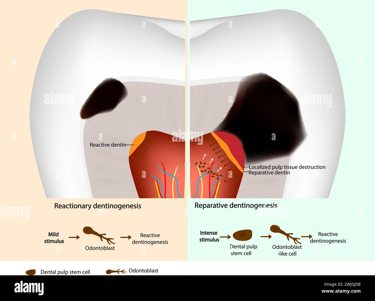 Tertiäre Dentinbildung. Reparative Dentinogenese und reaktive Dentinogenese. Odontoblast und Zahnpulpenstammzelle Stock Vektor