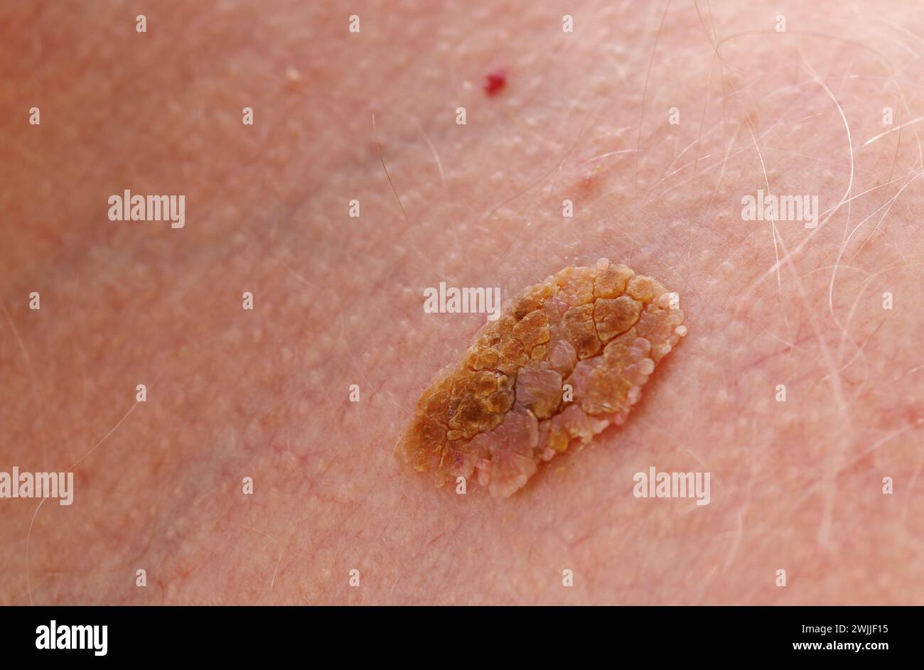 Benigne Melanome - maligner Tumor der Haut. Stockfoto
