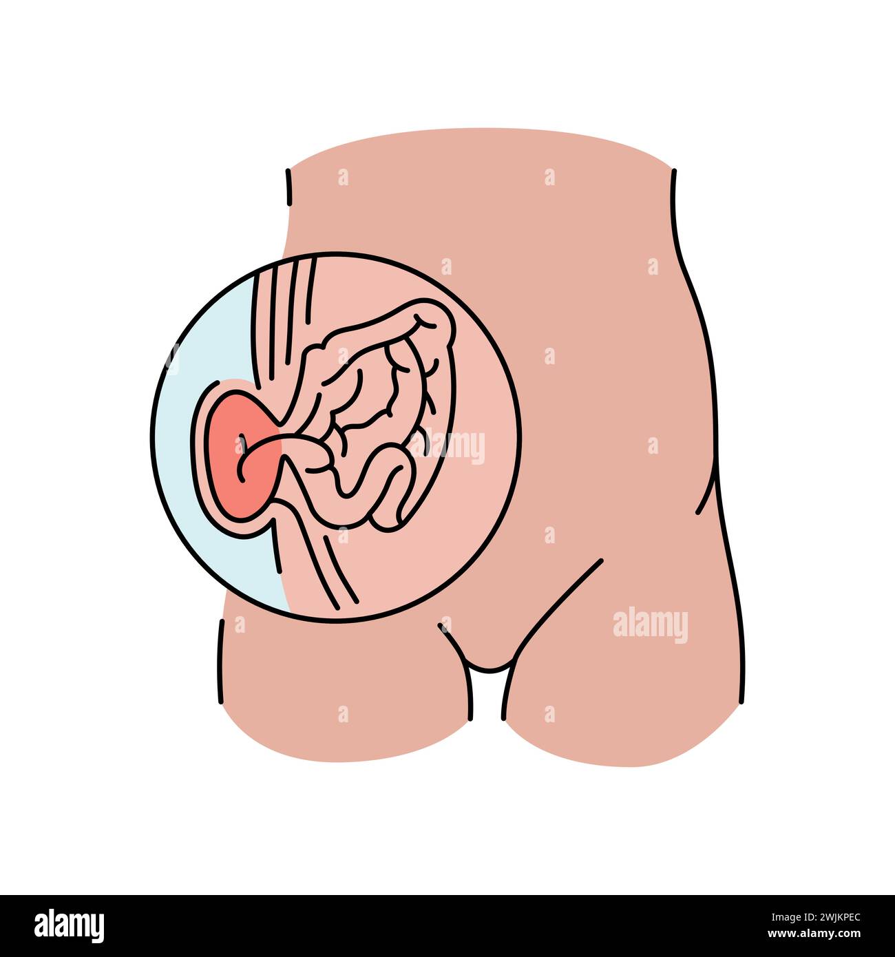 Strangulierte Hernienlinie. Vektorisoliertes Element. Bearbeitbare Kontur. Stock Vektor