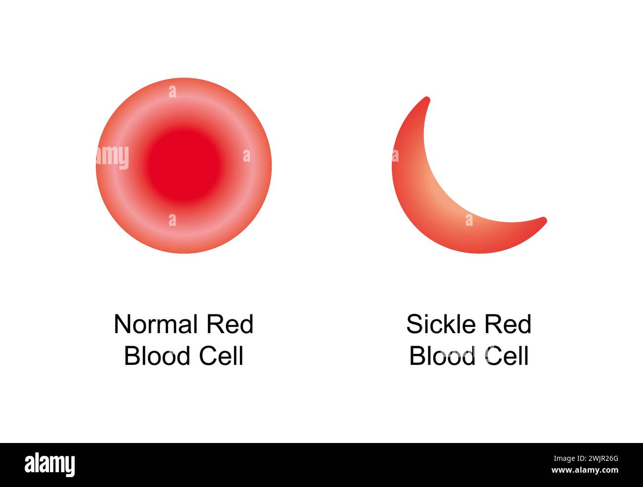Normale und sichelrote Blutzellen, Illustration Stockfoto