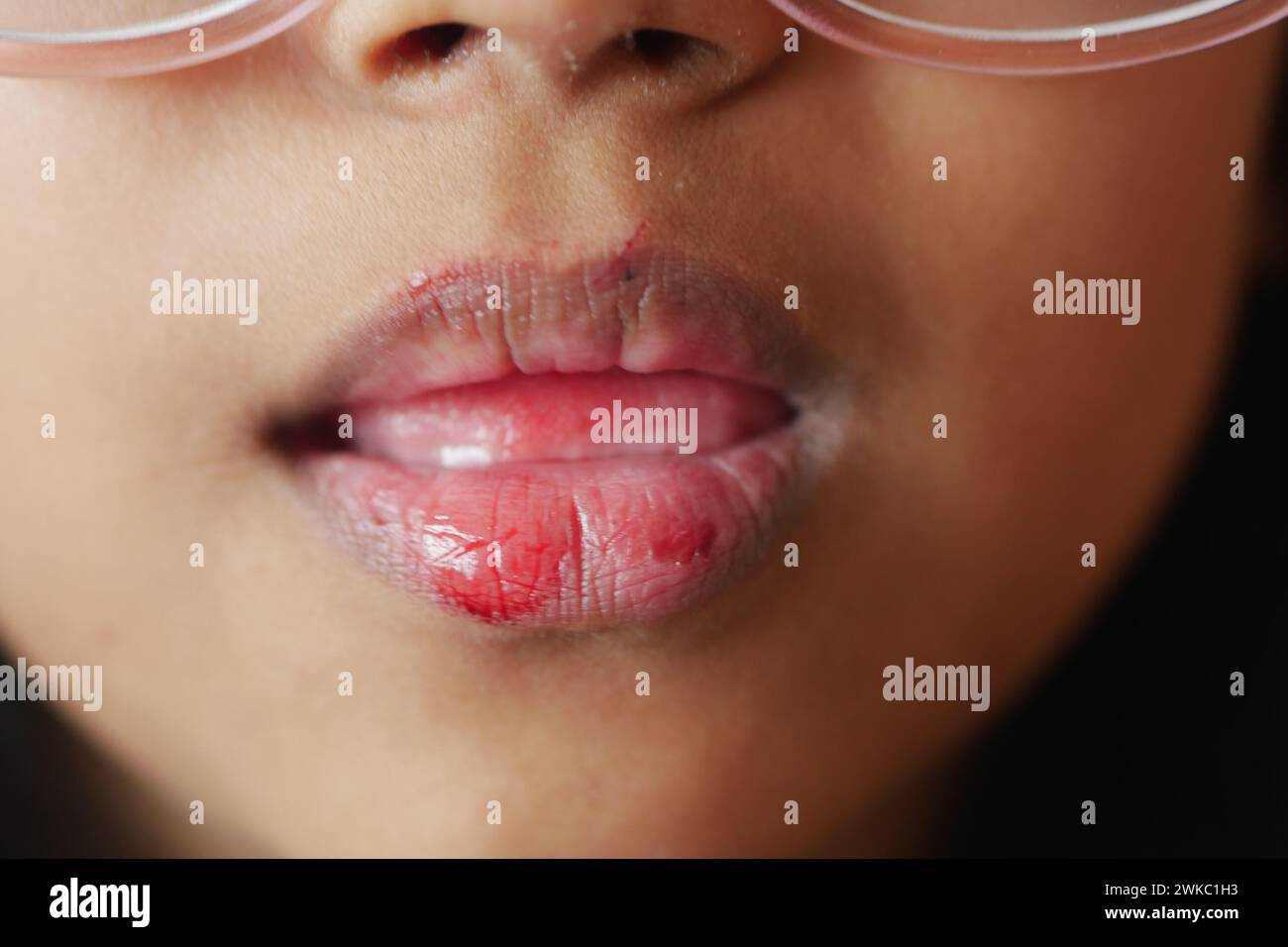 Nahaufnahme der trockenen Lippe eines Kindes Stockfoto