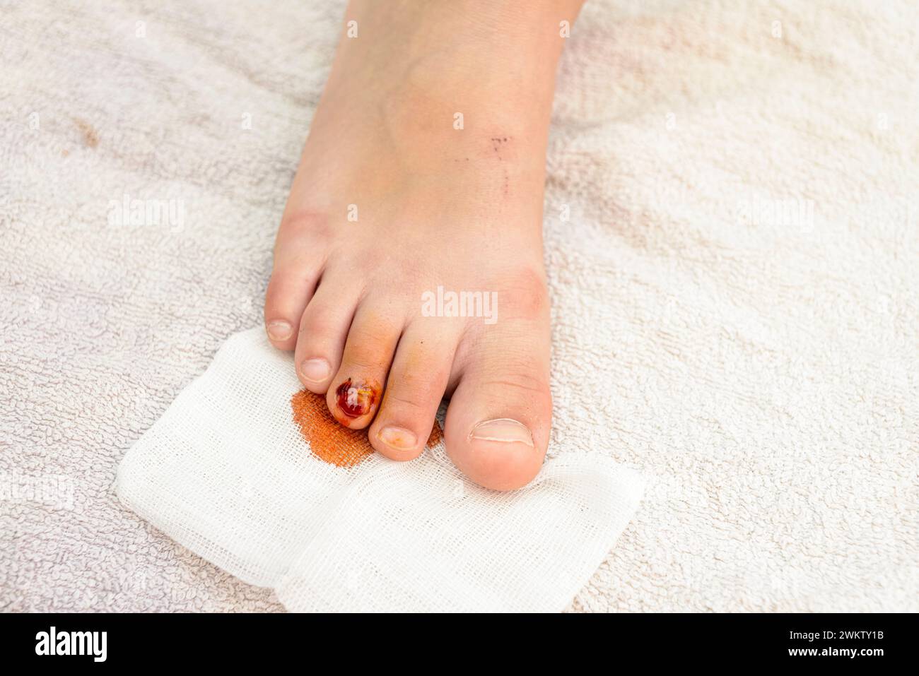Detail einer Verletzung des Zehennagels eines Kindes. Im Sommer sind kleine Unfälle im Haus und Verletzungen barfuß häufig. Stockfoto