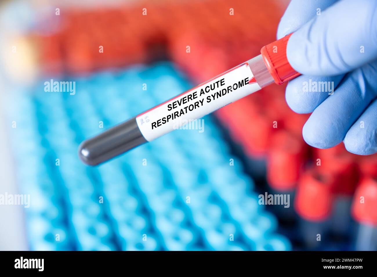 Bluttest bei schwerem akutem respiratorischem Syndrom Stockfoto