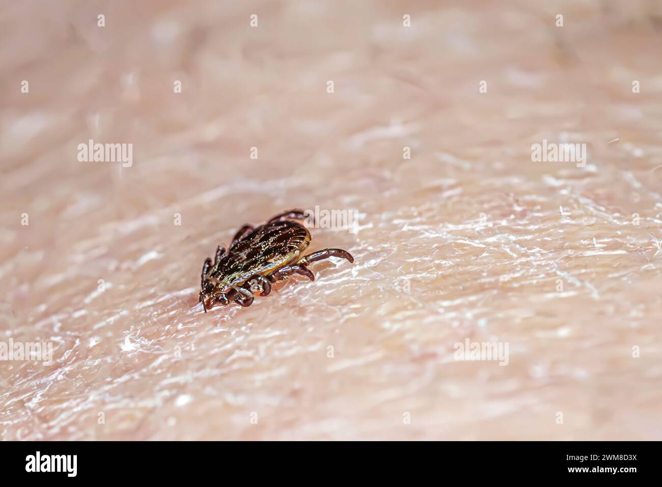 Zecken graben in menschliche Haut Close-up von A. Zecken Saison und lyme-Borreliose Konzept. Stockfoto