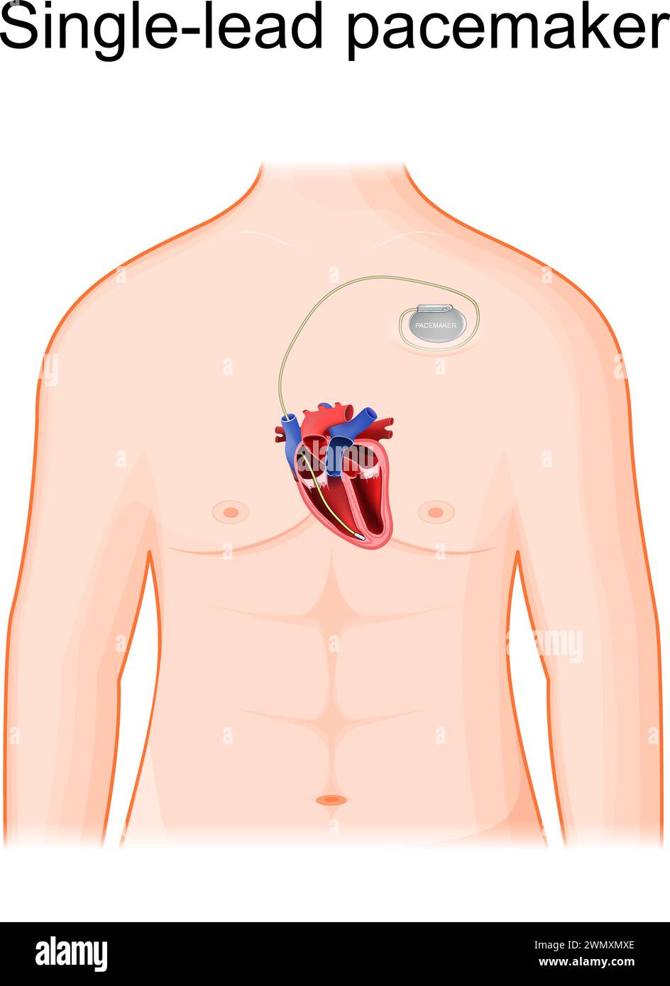 Einkanal-Schrittmacherplatzierung. Menschlicher Körper mit Herzquerschnitt und künstlichem Herzschrittmacher. Es wird nur eine Stimulationselektrode in eine Kammer gelegt Stock Vektor