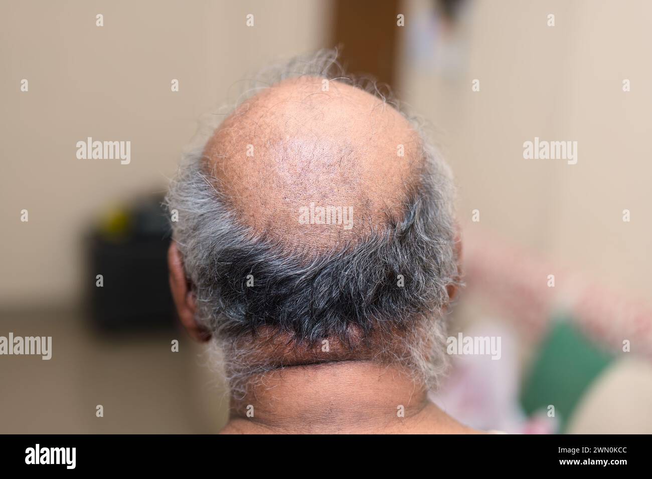 Ein nachdenklicher Seniorenmann mit sichtbarer Haarverdünnung untersucht seine Kopfhaut Stockfoto