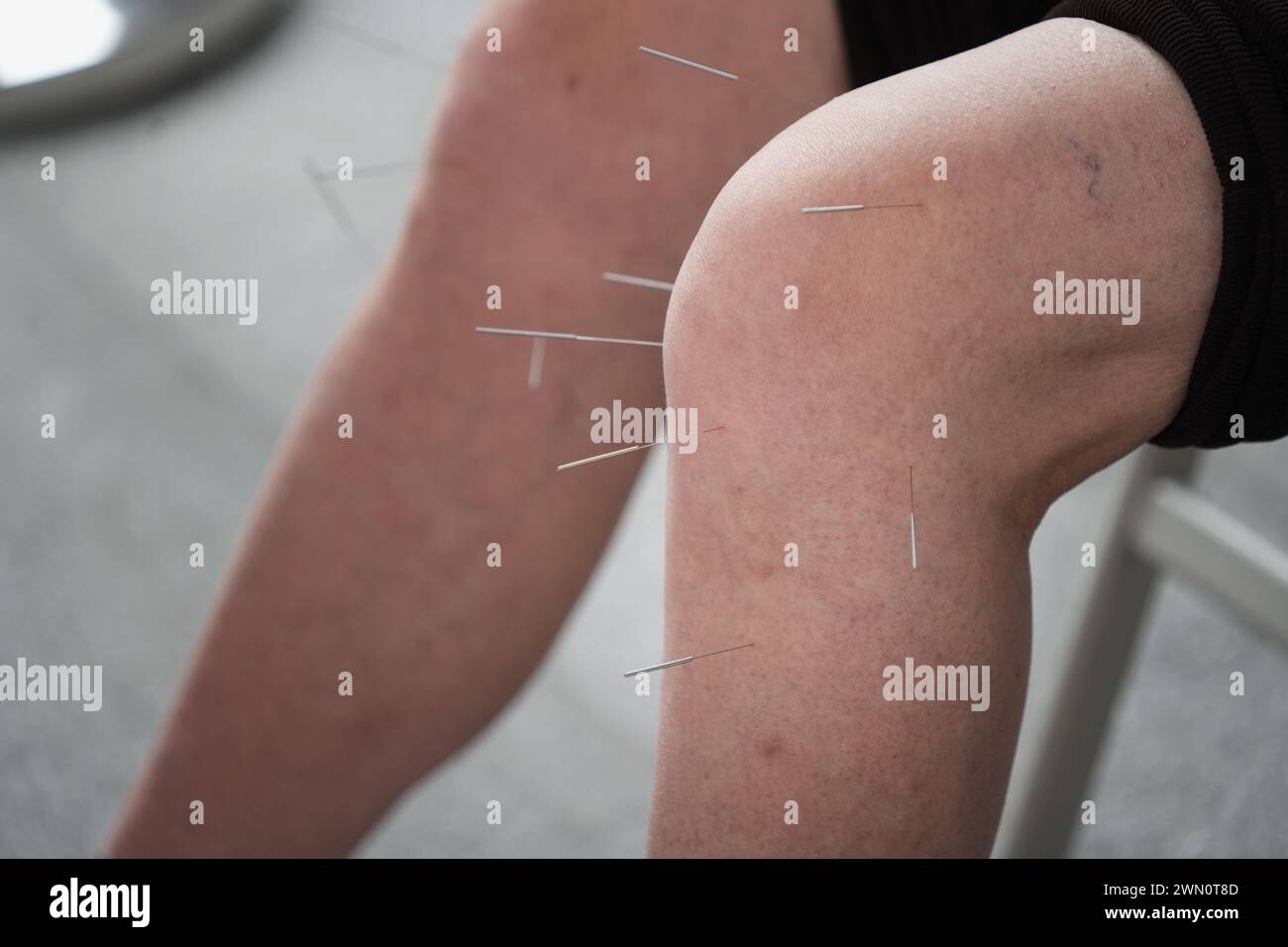 Nahaufnahme einer Akupunkturbehandlung in einer Arztpraxis Stockfoto