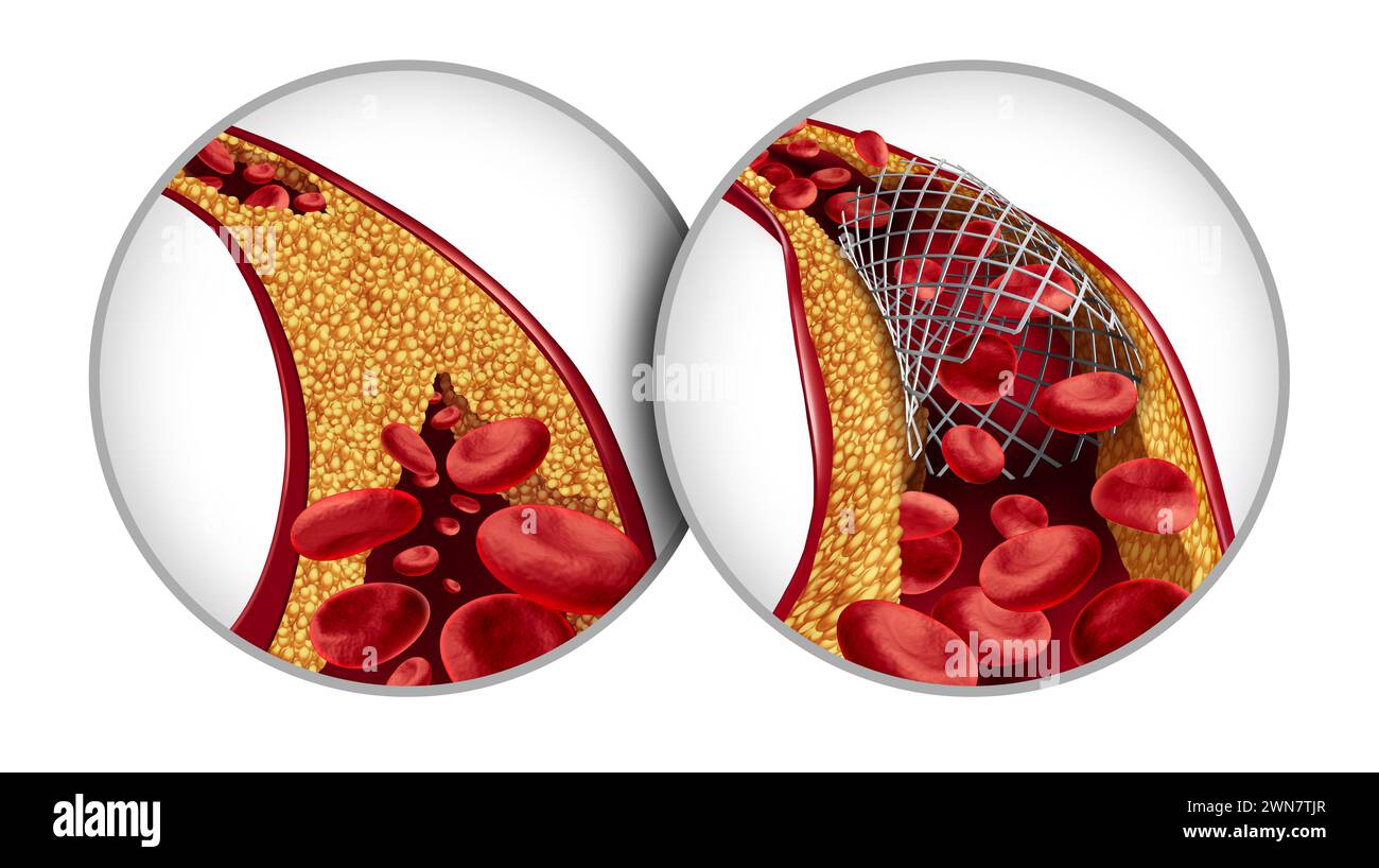 Stents in der Angioplastie und Stentmedizinisches Implantatkonzept Behandlungssymbol als chirurgisches Verfahren in einer Arterie mit Cholesterinplaqueblockerung bei Stockfoto