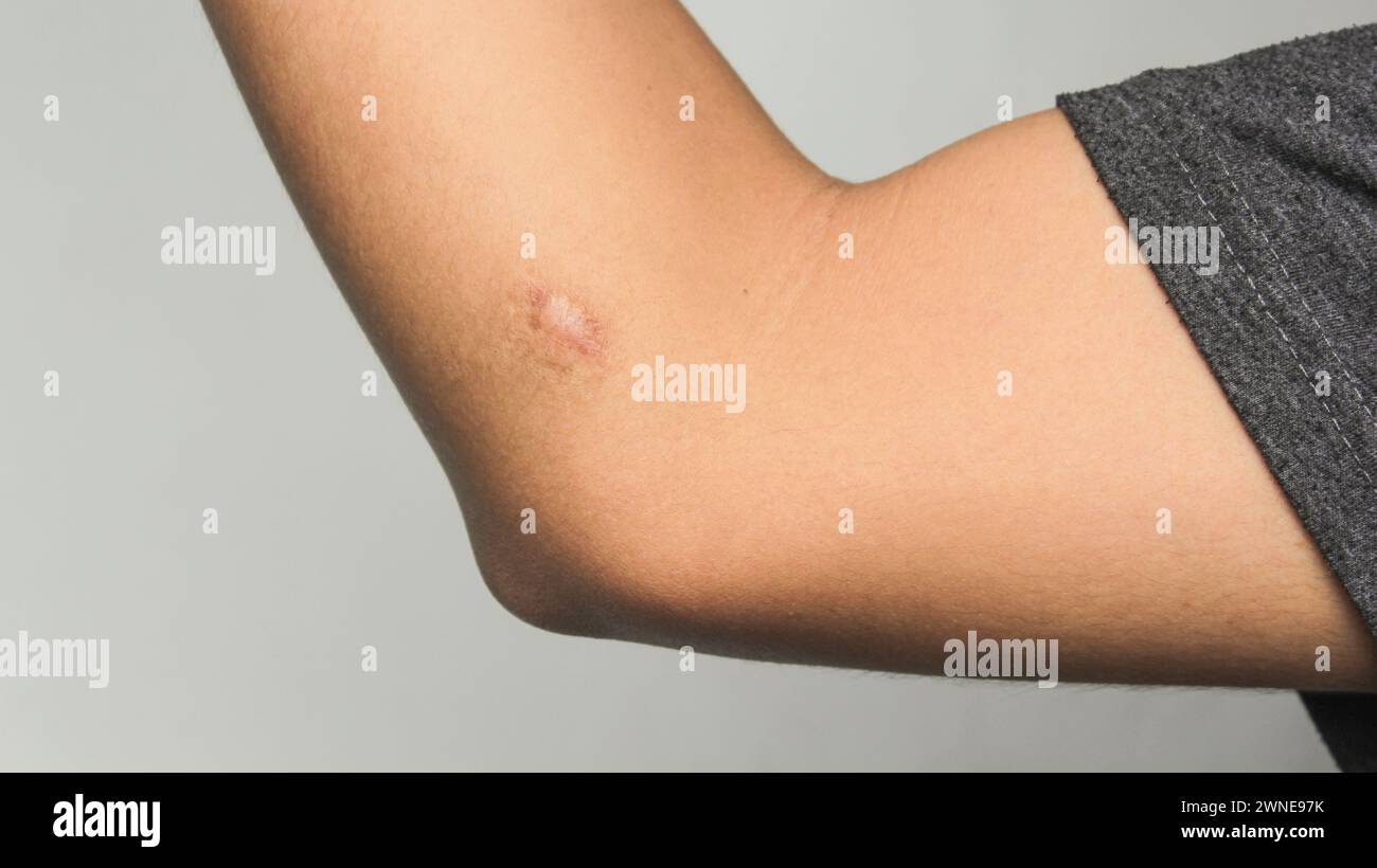 Narbe am menschlichen Hautkeloid am Ellenbogen. Stockfoto