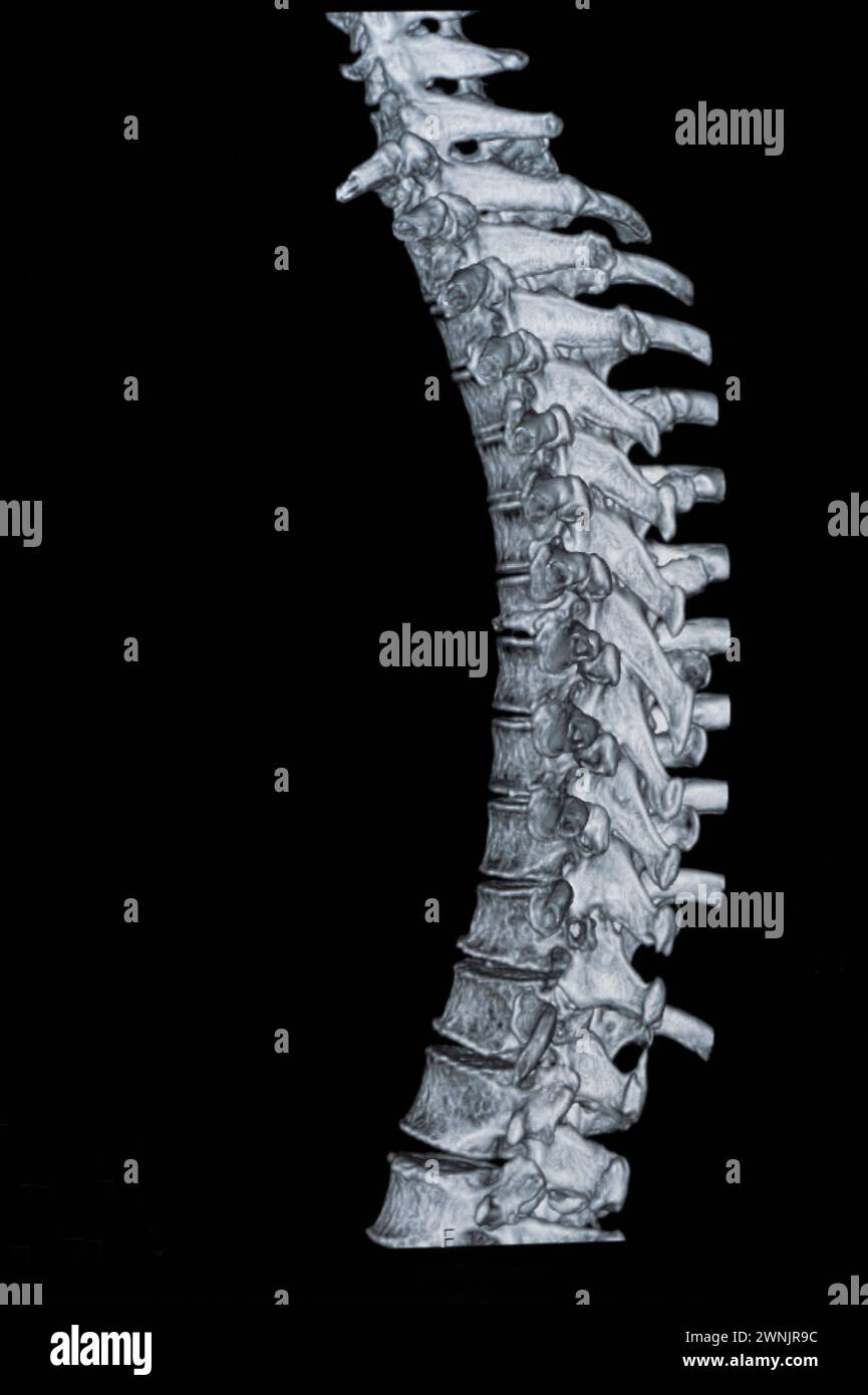 Spinale mrt-Bilder Stockfoto