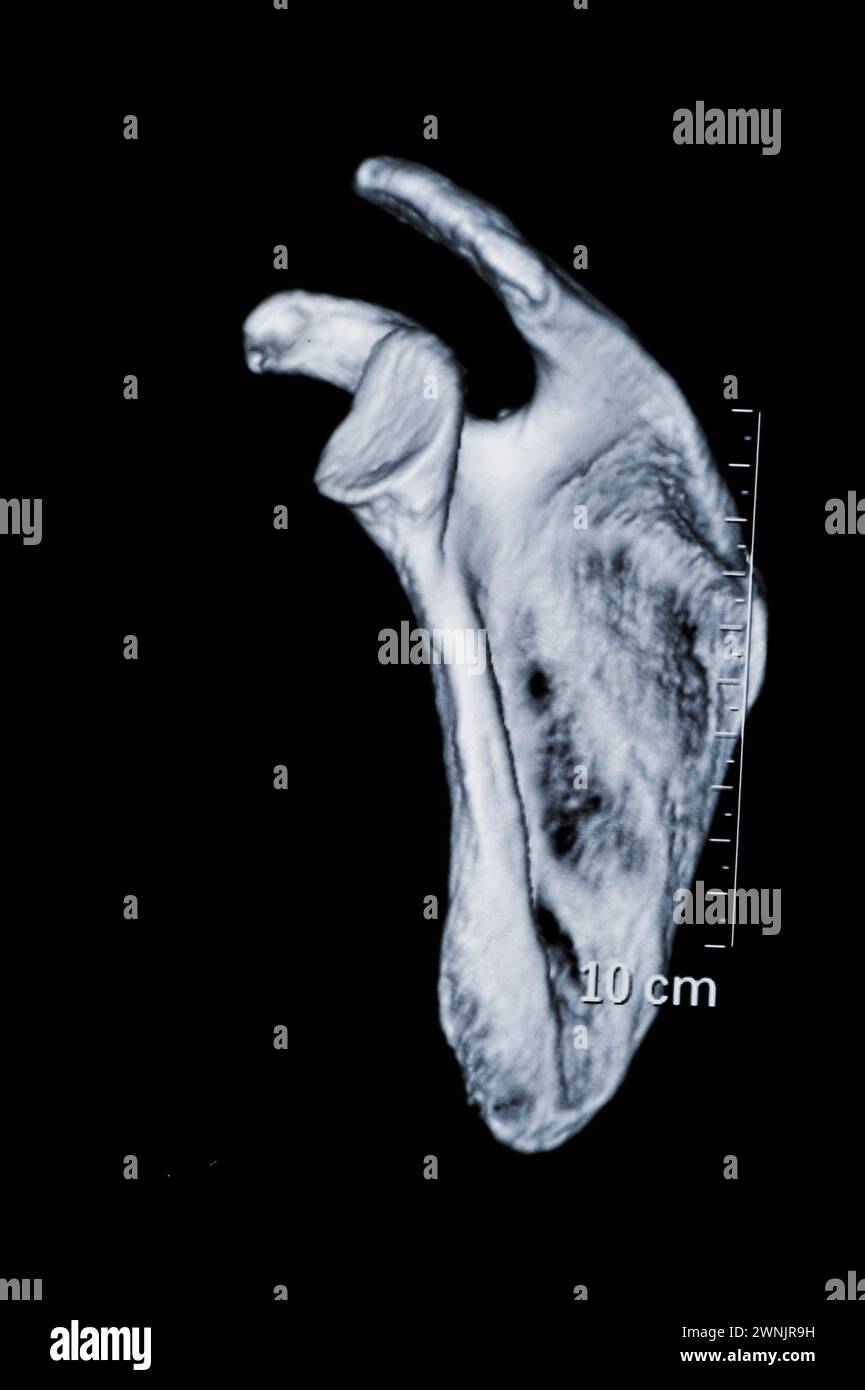 Human Bone CT-Bilder Stockfoto