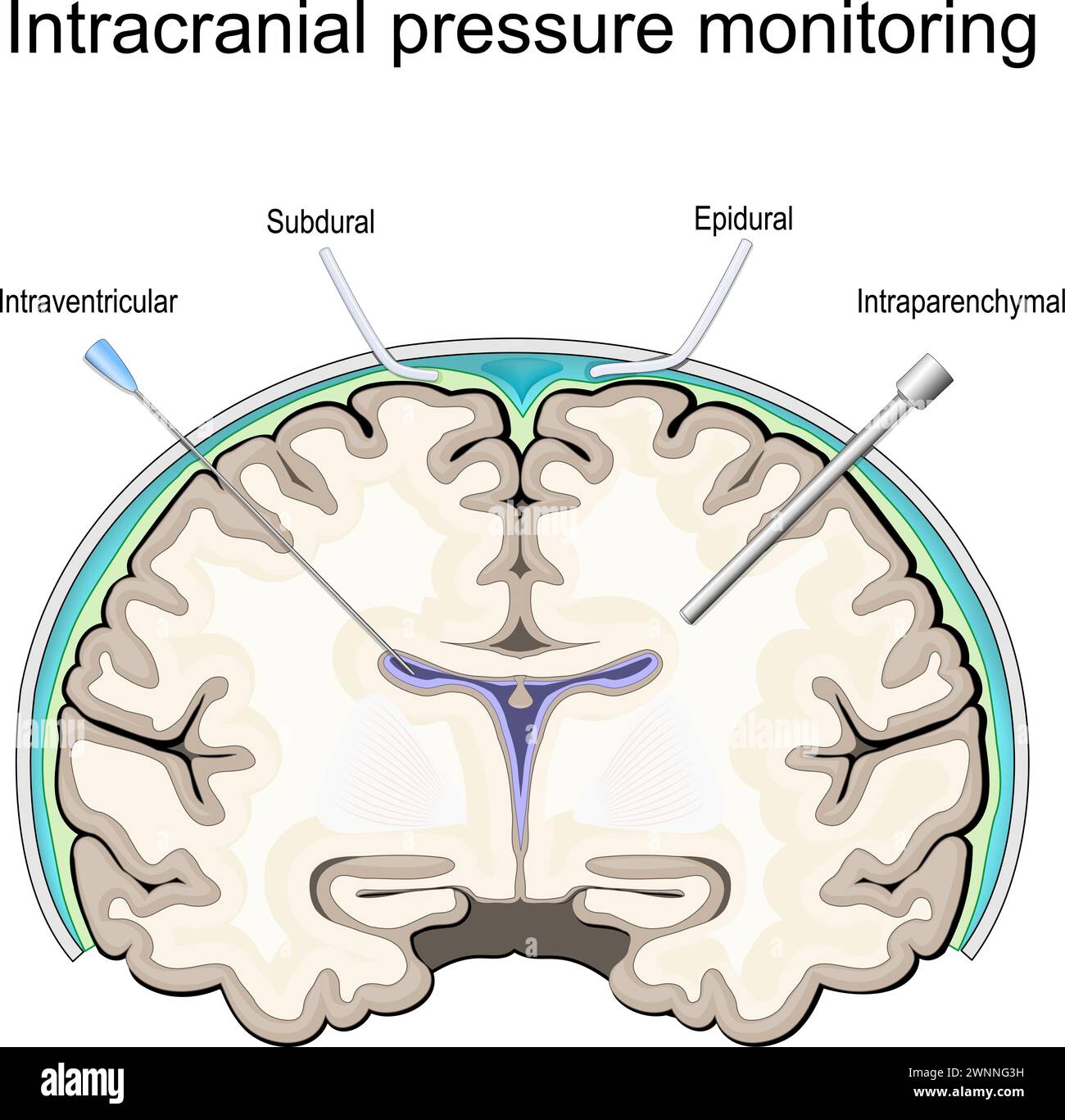 Intrakranieller Druck. ICP-Überwachung. Querschnitt eines menschlichen Gehirns. Lokalisationen von Drucksonden oder Kathetern. Epidural, Subdural, Parenchym, Stock Vektor