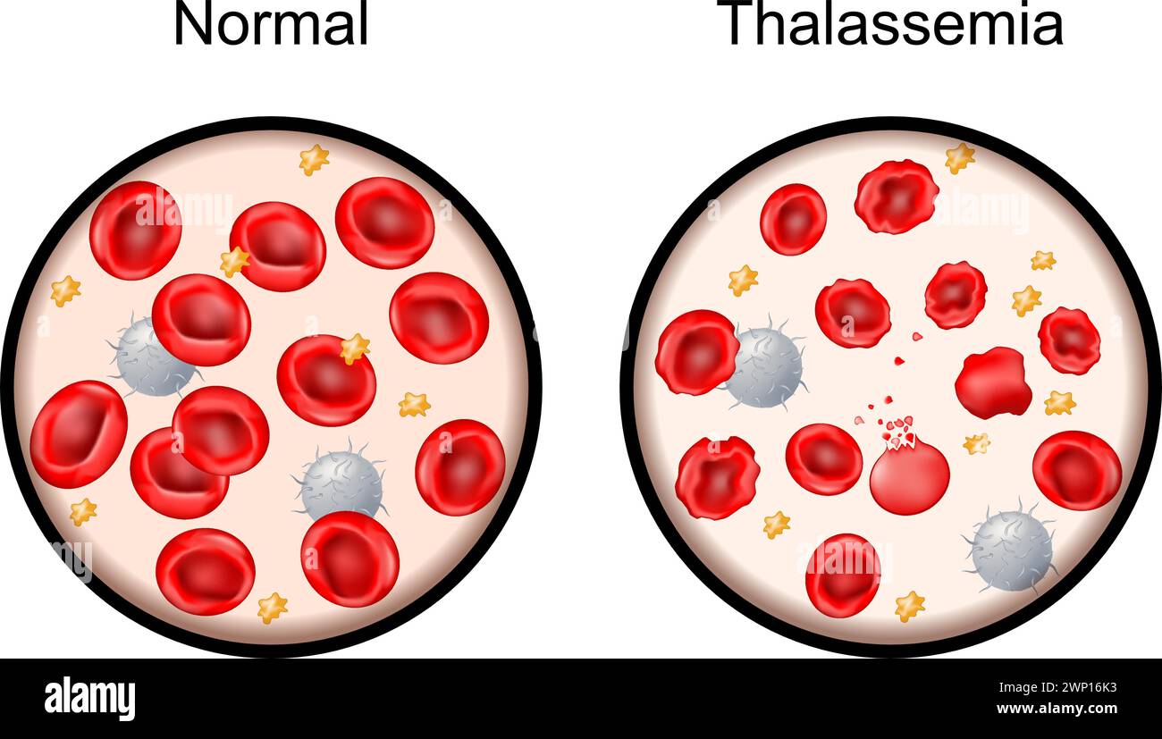 Thalassämie. Nahaufnahme normaler roter Blutzellen und geschädigter Blutzellen. Mediterrane Anämie. Vererbte Blutstörungen, die zu abnormer Hämoglobinkonzentration führen Stock Vektor
