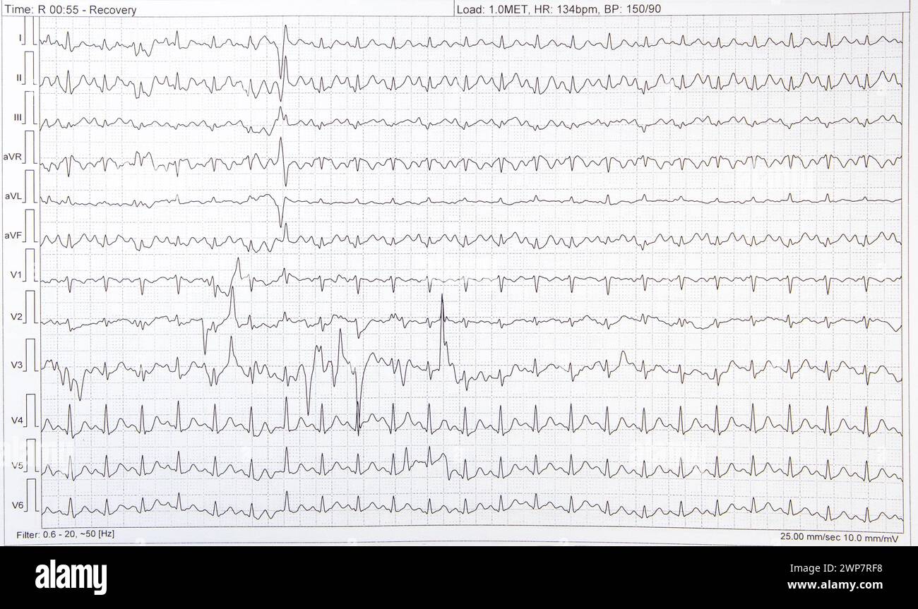 Ein graphisches EKG-Elektrokardiogramm einer Herzkranken Stockfoto