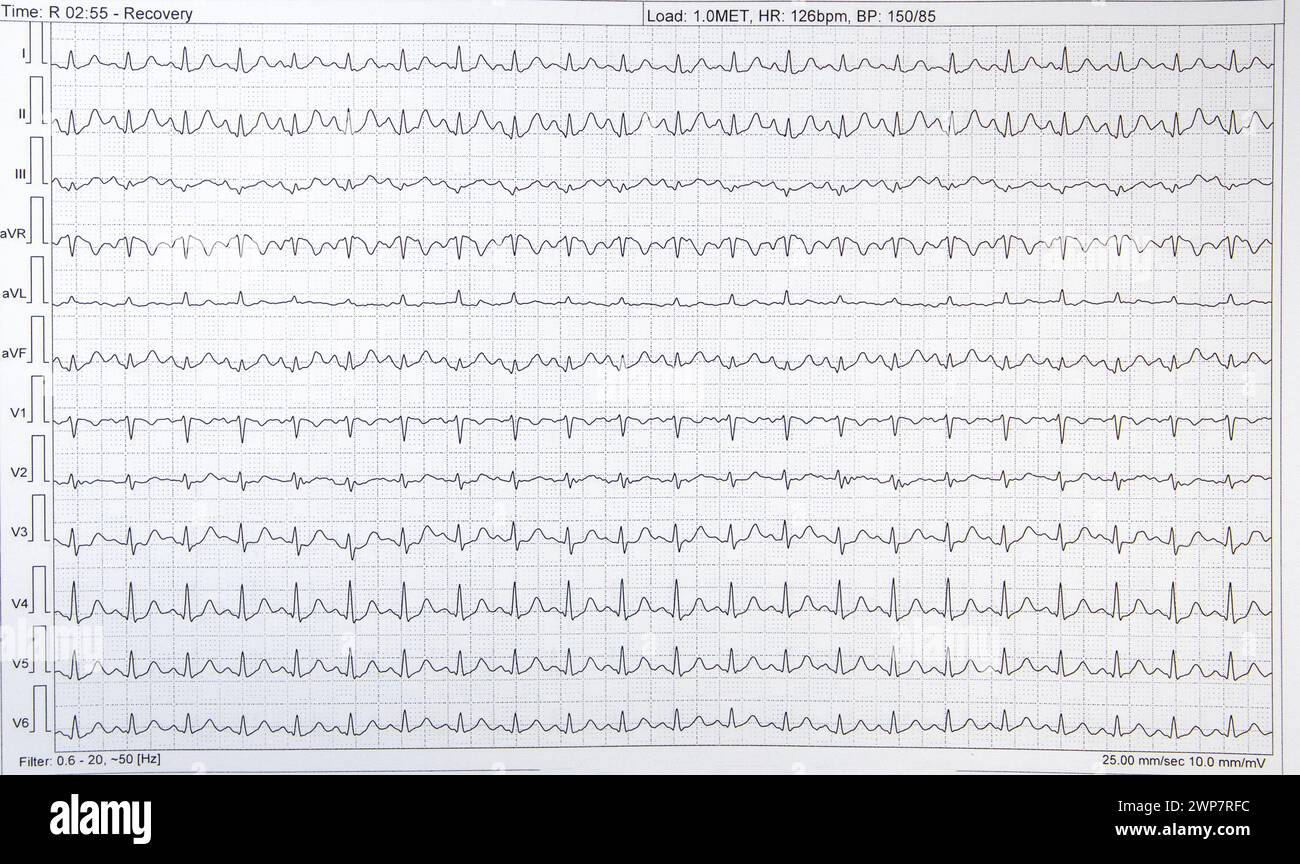 Ein graphisches EKG-Elektrokardiogramm einer Herzkranken Stockfoto