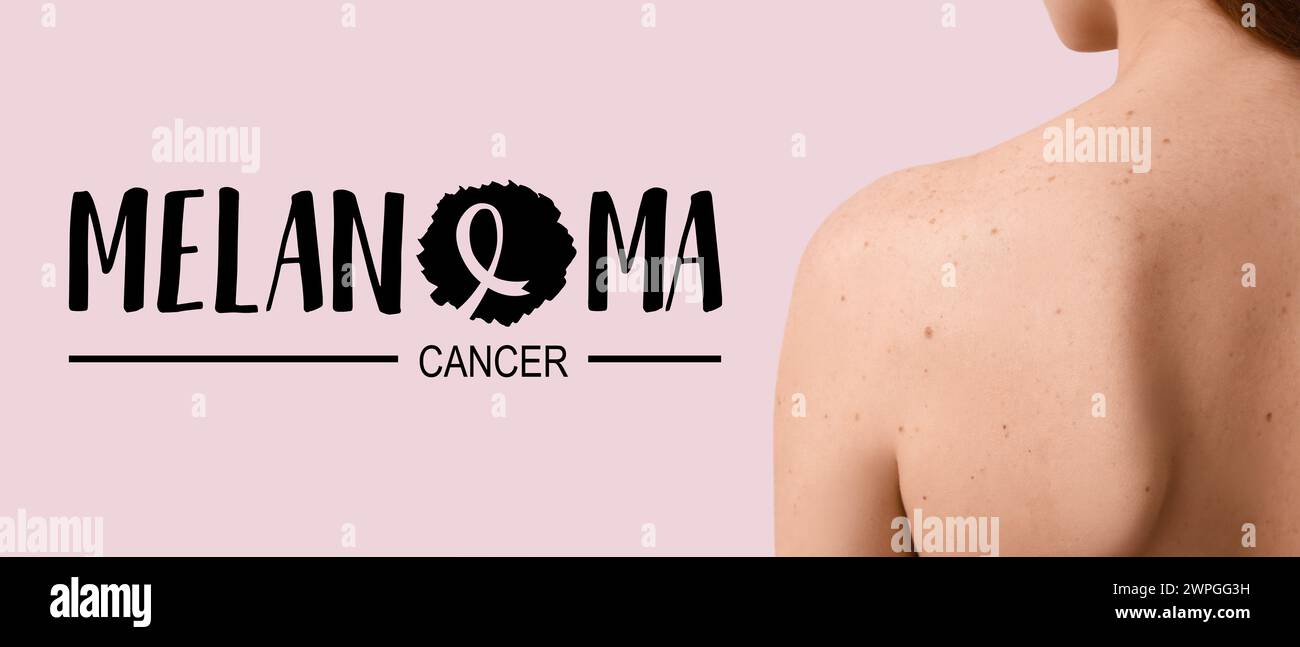 Junge Frau mit Muttermalen und TEXTMELANOMKREBS auf rosa Hintergrund Stockfoto