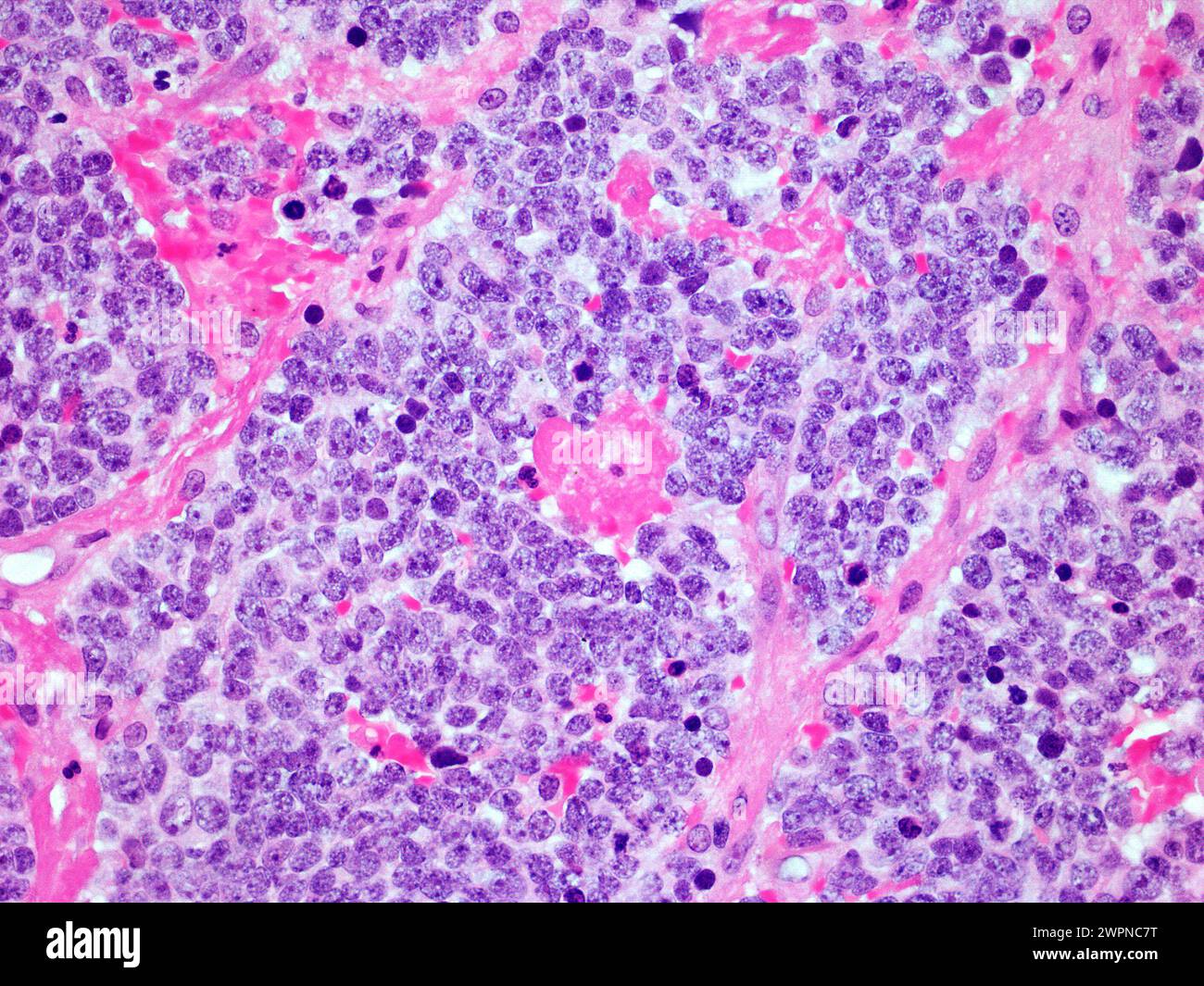 Mikroskopisches Bild eines malignen Neuroblastoms der Nebenniere bei 300-facher Vergrößerung mit Hämatoxylin- und Eosin-Färbung Stockfoto